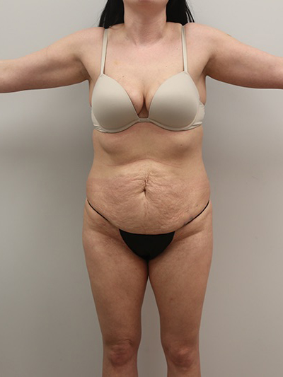 Liposuction Before & After Image