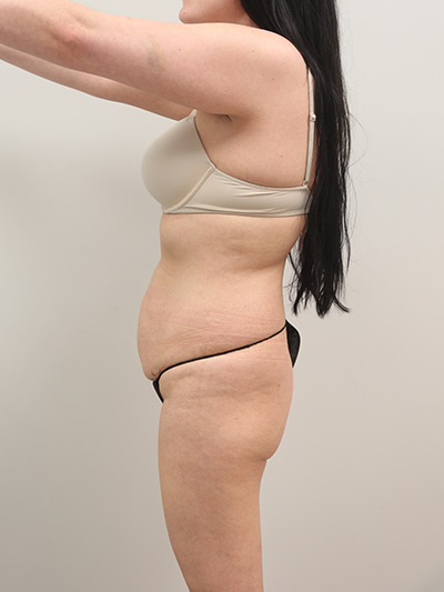 Liposuction Before & After Image