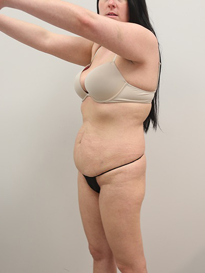 Liposuction Before & After Image