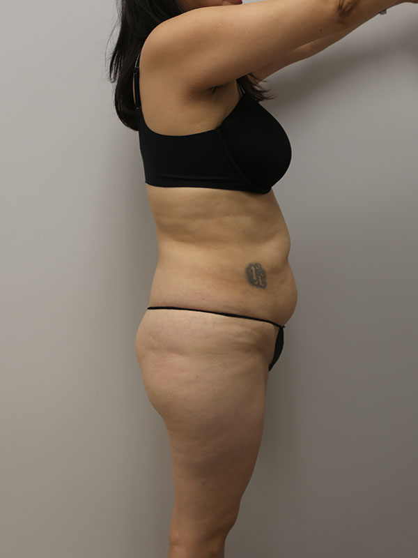 Liposuction Before & After Image