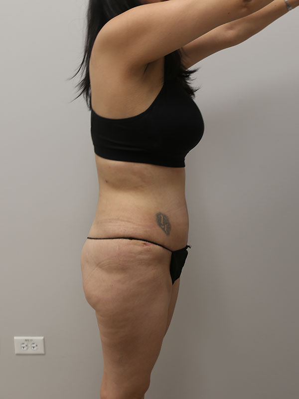 Liposuction Before & After Image