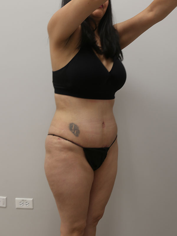Liposuction Before & After Image