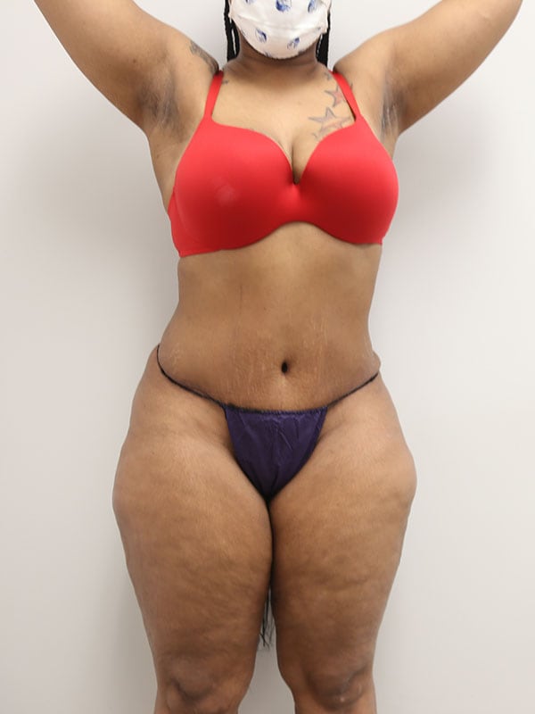 Liposuction Before & After Image