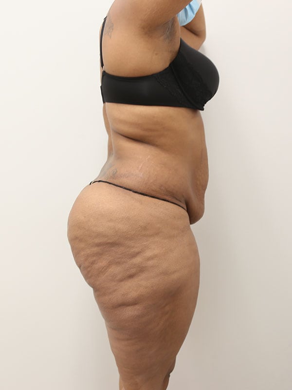 Liposuction Before & After Image