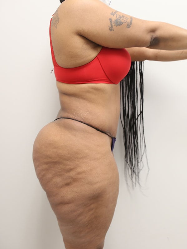 Liposuction Before & After Image