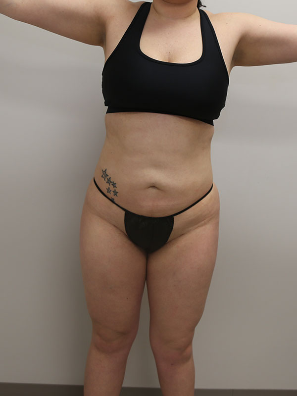 Liposuction Before & After Image