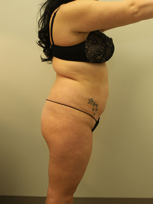 Liposuction Before & After Image