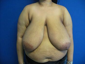 Mommy Makeover Before & After Image