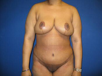 Mommy Makeover Before & After Image