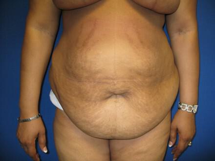 Mommy Makeover Before & After Image