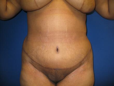 Mommy Makeover Before & After Image