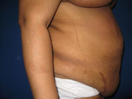 Mommy Makeover Before & After Image