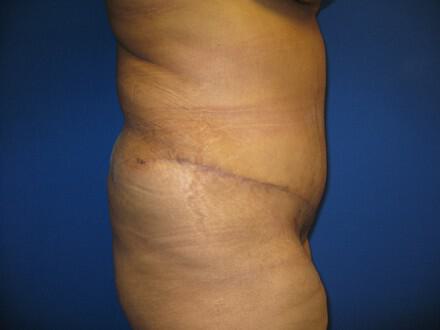 Mommy Makeover Before & After Image