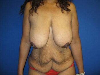 Mommy Makeover Before & After Image