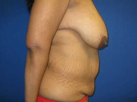 Mommy Makeover Before & After Image