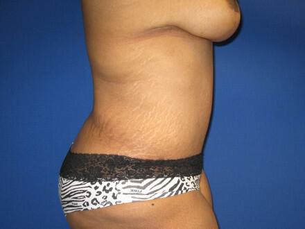 Mommy Makeover Before & After Image