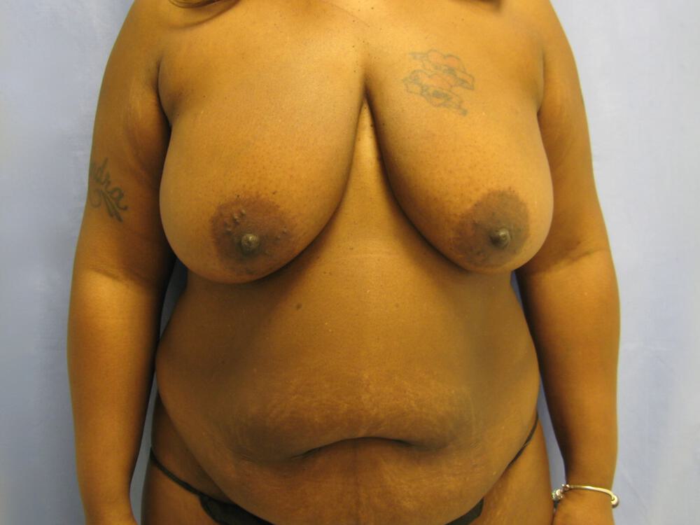 Mommy makeover Before & After Image