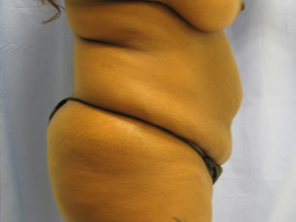 Mommy makeover Before & After Image