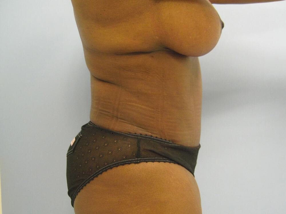 Mommy makeover Before & After Image