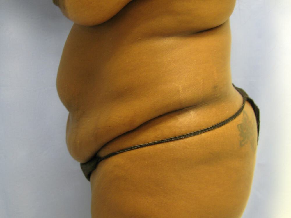 Mommy Makeover Before & After Image