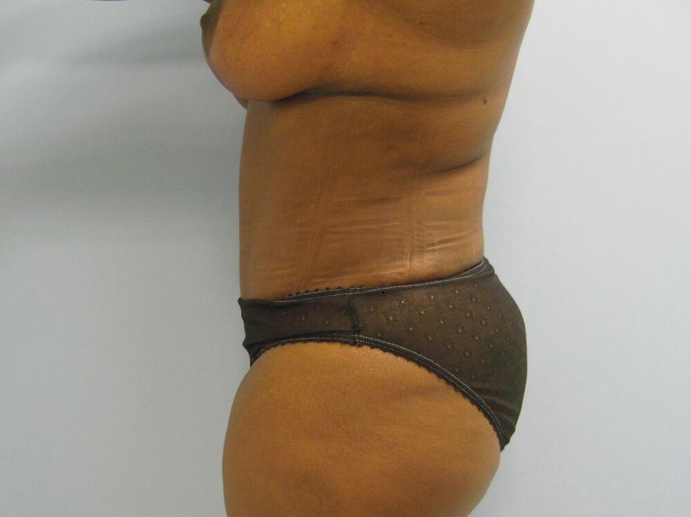 Mommy Makeover Before & After Image