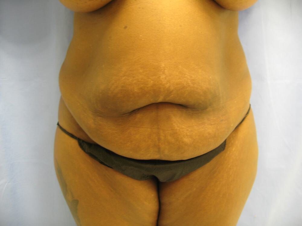 Mommy Makeover Before & After Image