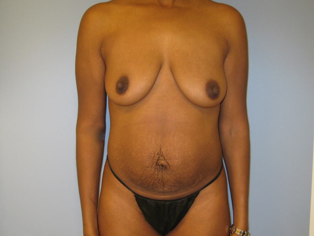 Mommy makeover Before & After Image