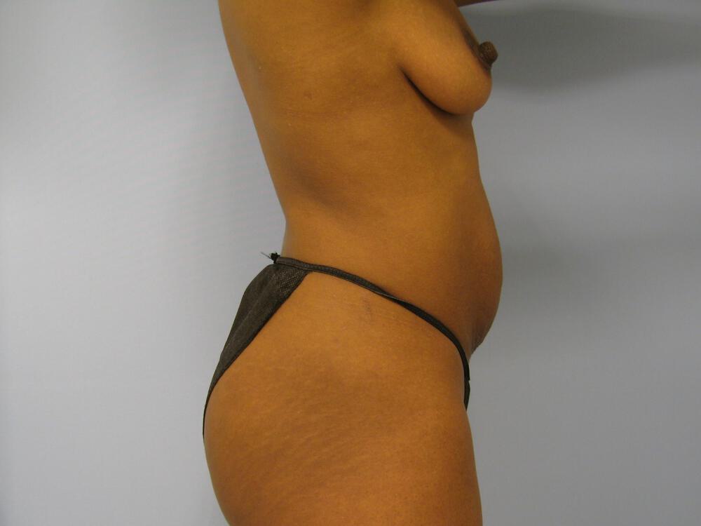 Mommy makeover Before & After Image