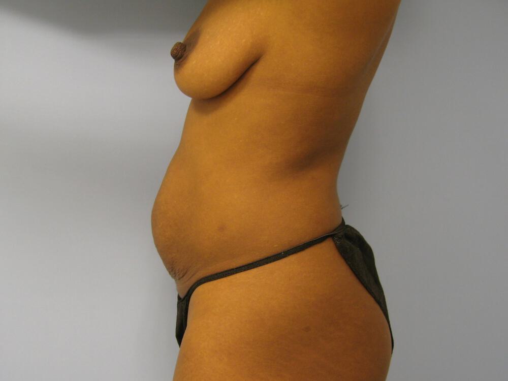 Mommy Makeover Before & After Image