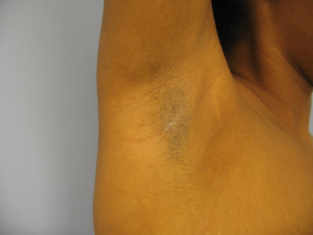 Mommy Makeover Before & After Image