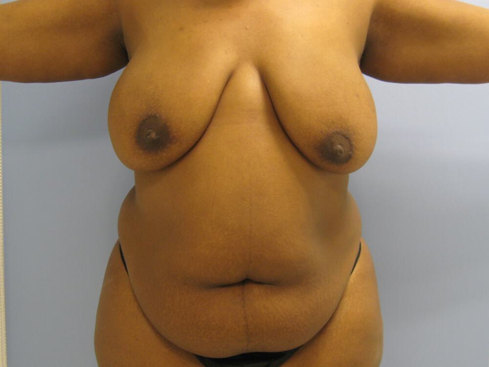 Mommy makeover Before & After Image