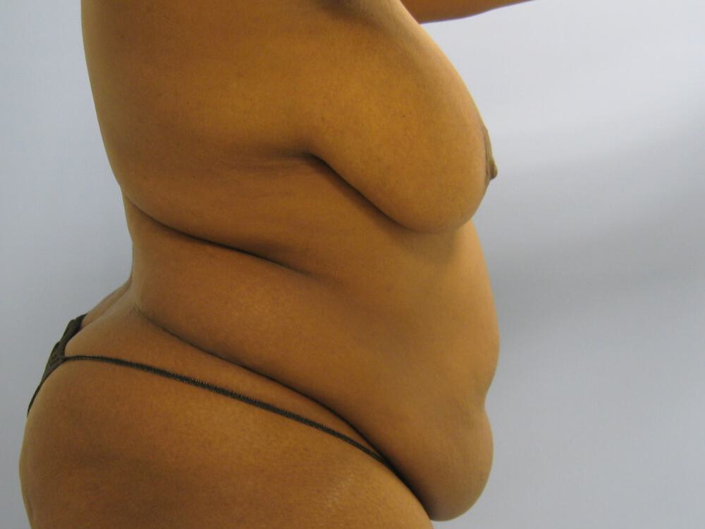 Mommy makeover Before & After Image