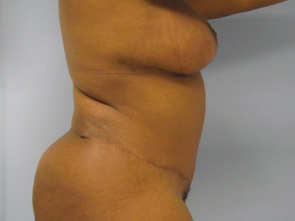 Mommy makeover Before & After Image