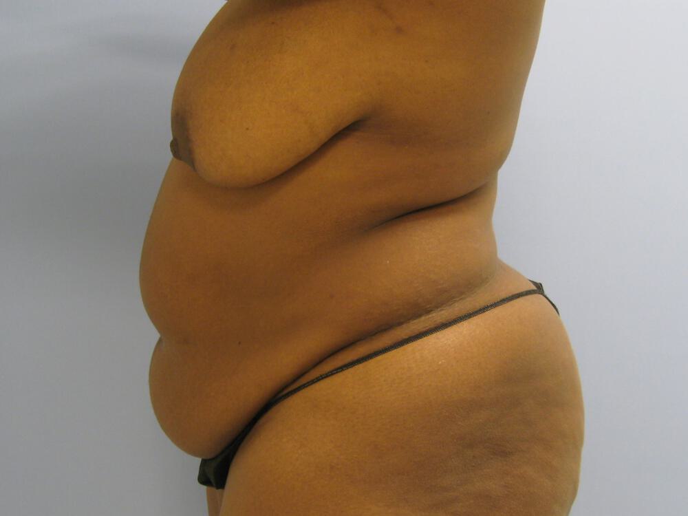 Mommy Makeover Before & After Image