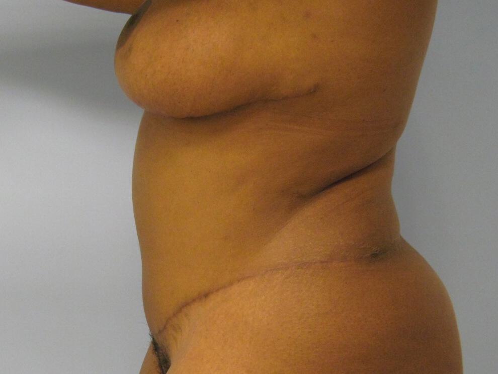 Mommy Makeover Before & After Image