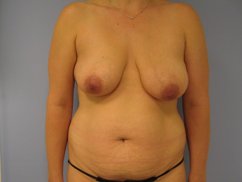 Mommy makeover Before & After Image