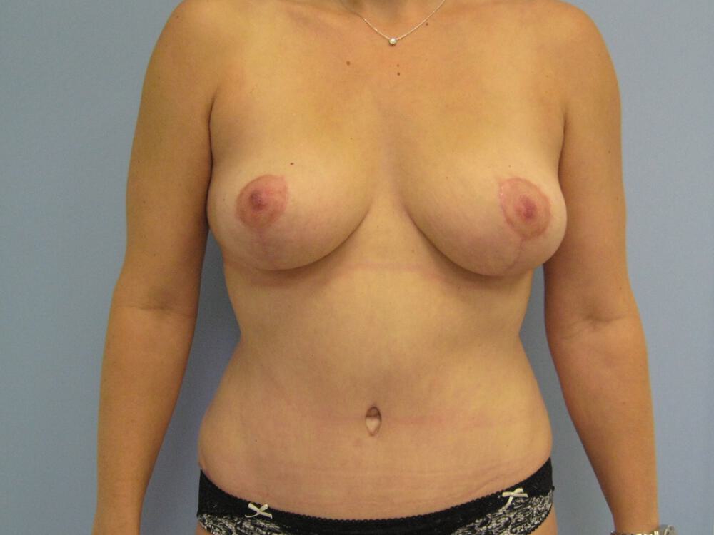 Mommy makeover Before & After Image