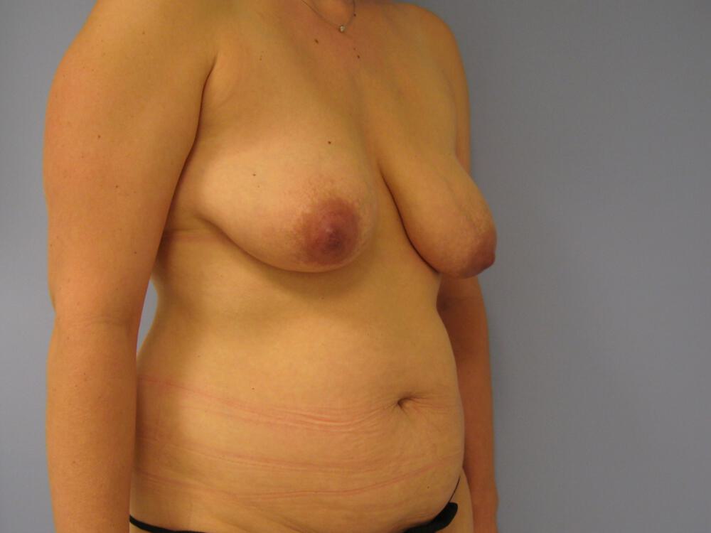 Mommy makeover Before & After Image