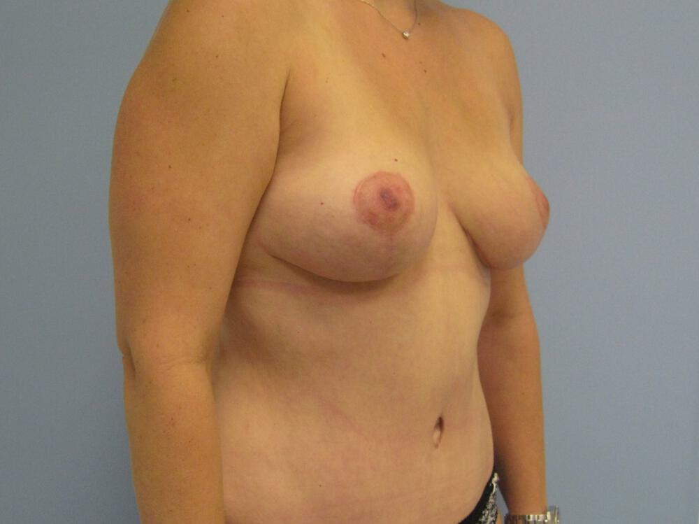 Mommy makeover Before & After Image