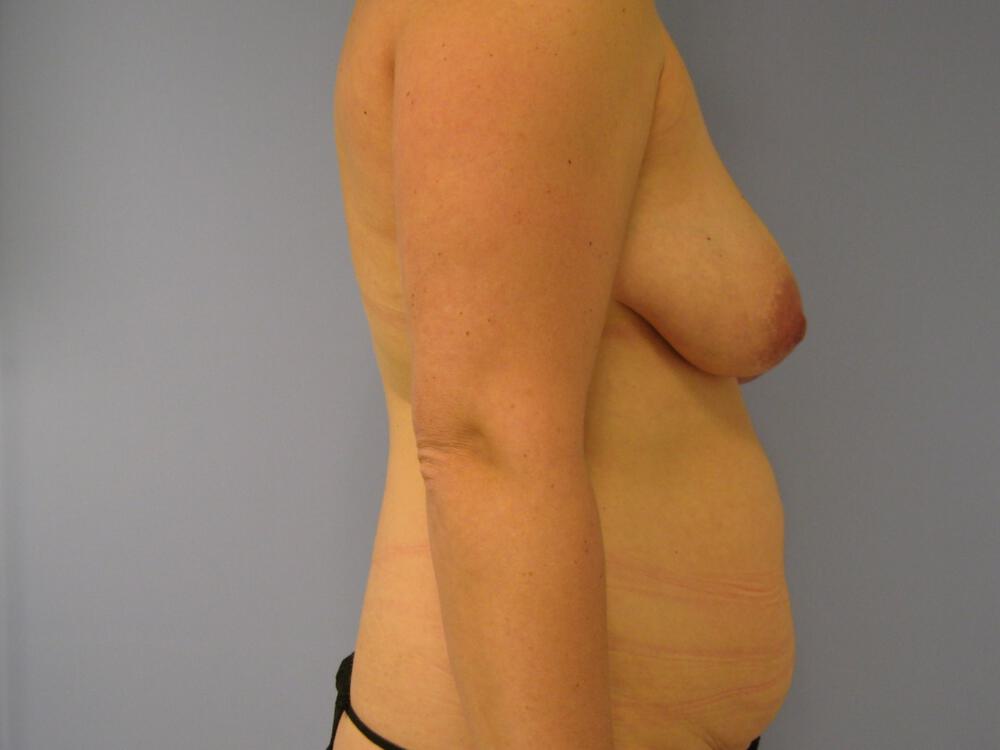 Mommy Makeover Before & After Image