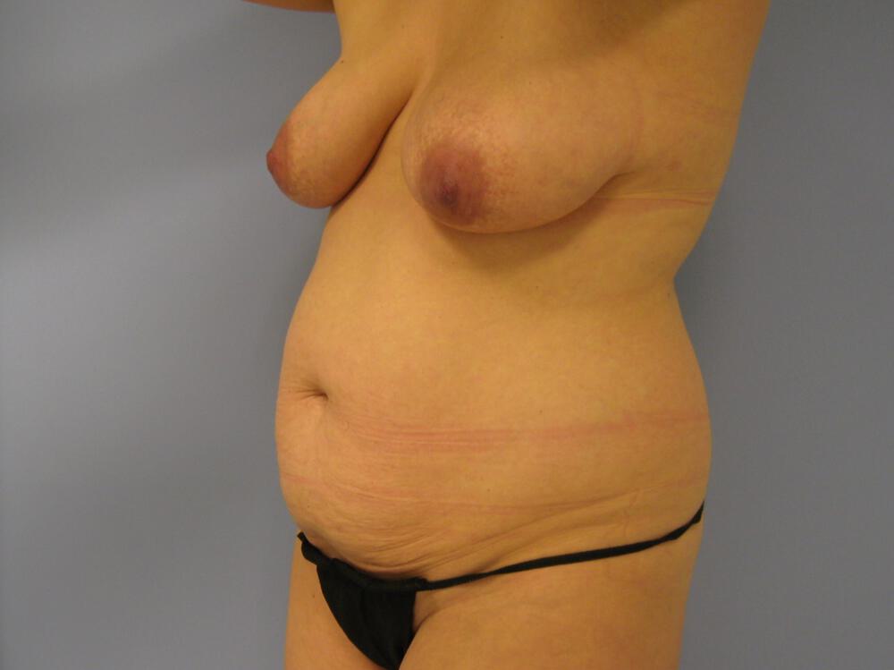 Mommy Makeover Before & After Image