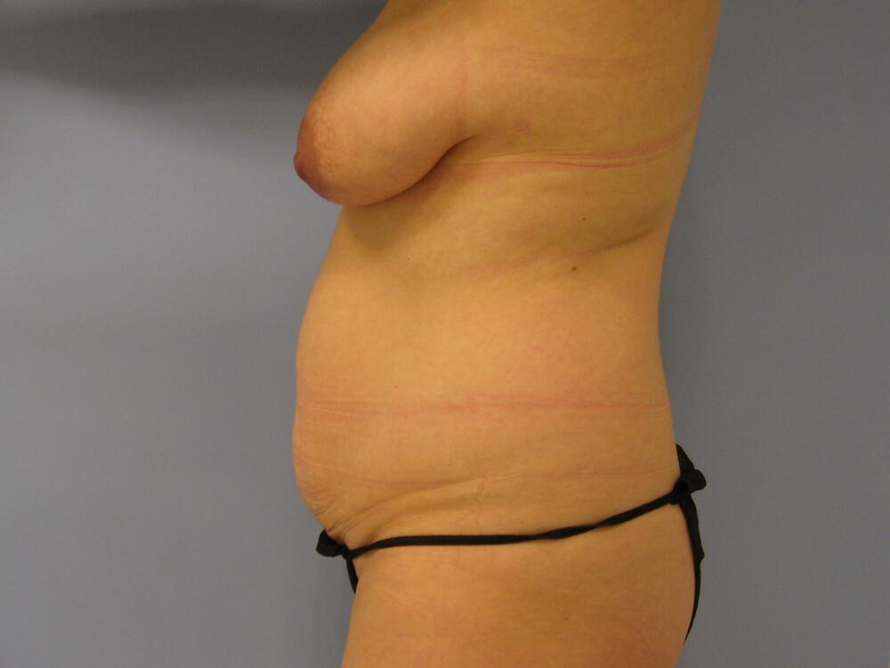 Mommy Makeover Before & After Image