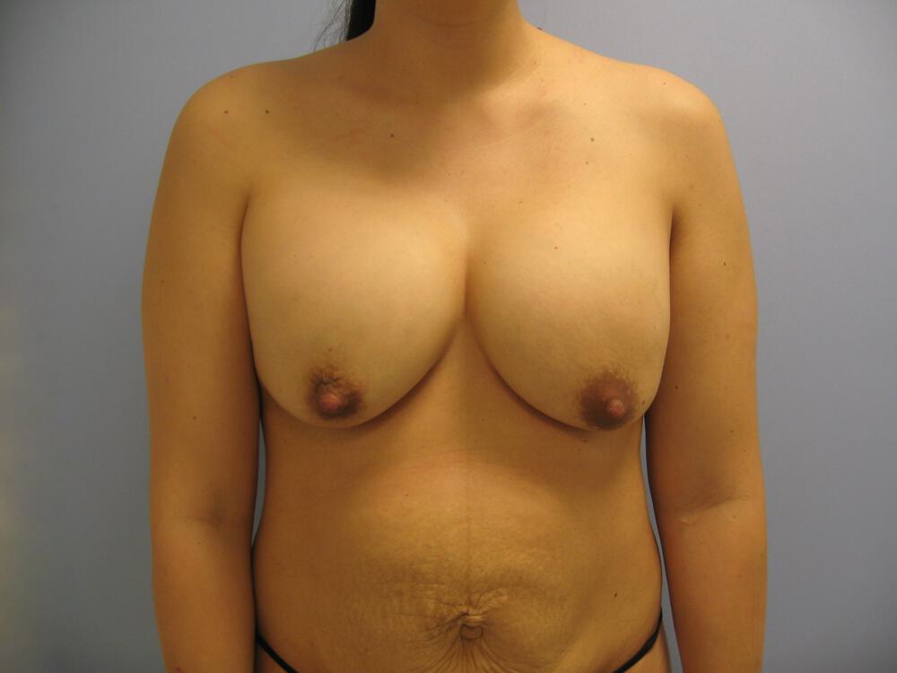 Mommy makeover Before & After Image