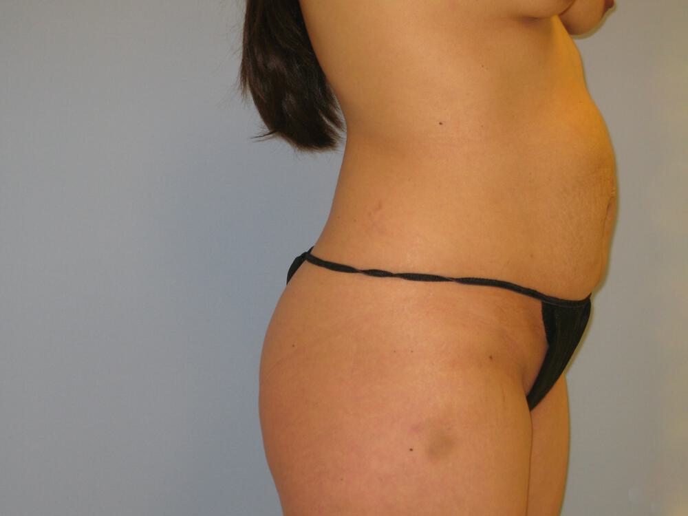 Mommy Makeover Before & After Image