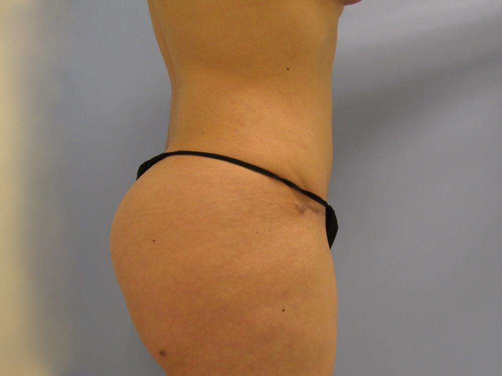 Mommy Makeover Before & After Image