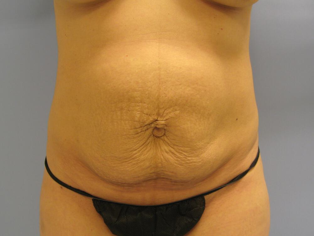 Mommy Makeover Before & After Image