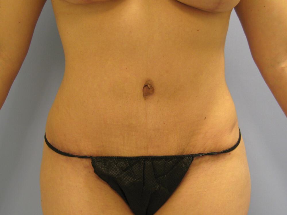 Mommy Makeover Before & After Image