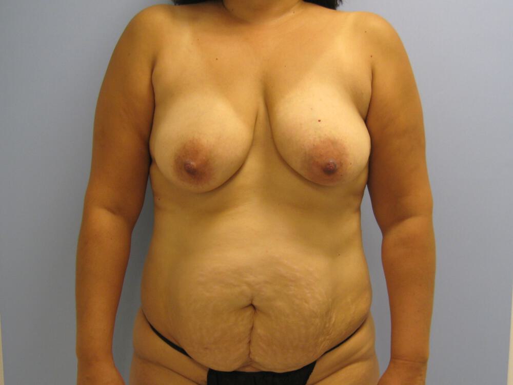 Mommy makeover Before & After Image
