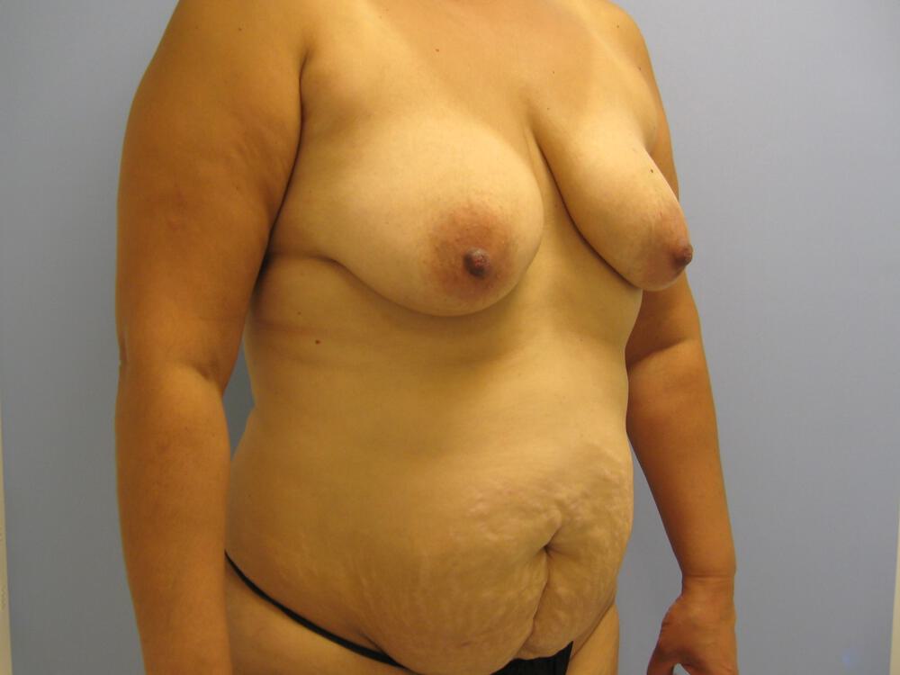 Mommy makeover Before & After Image