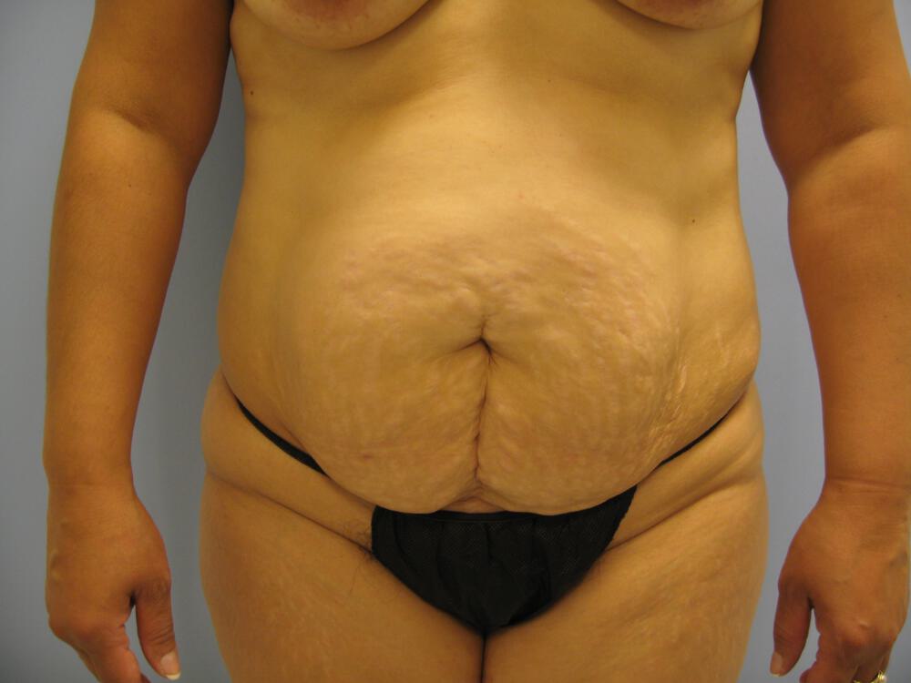 Mommy Makeover Before & After Image